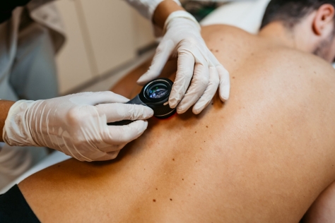Hautkrebs-Screening